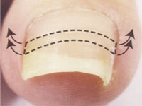 ビーエスブレイスクイック